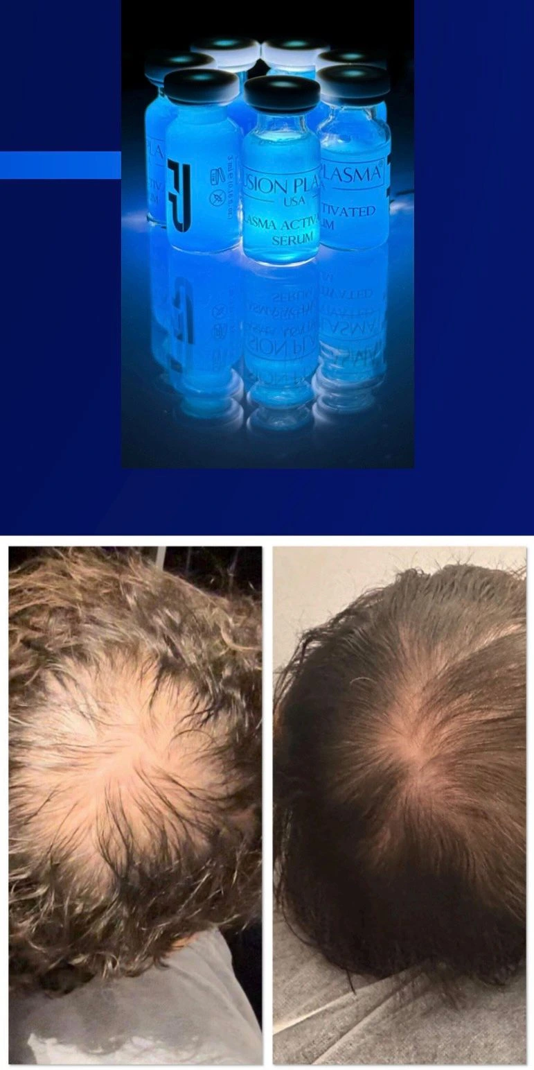 fusion-plasma-hair-restoration