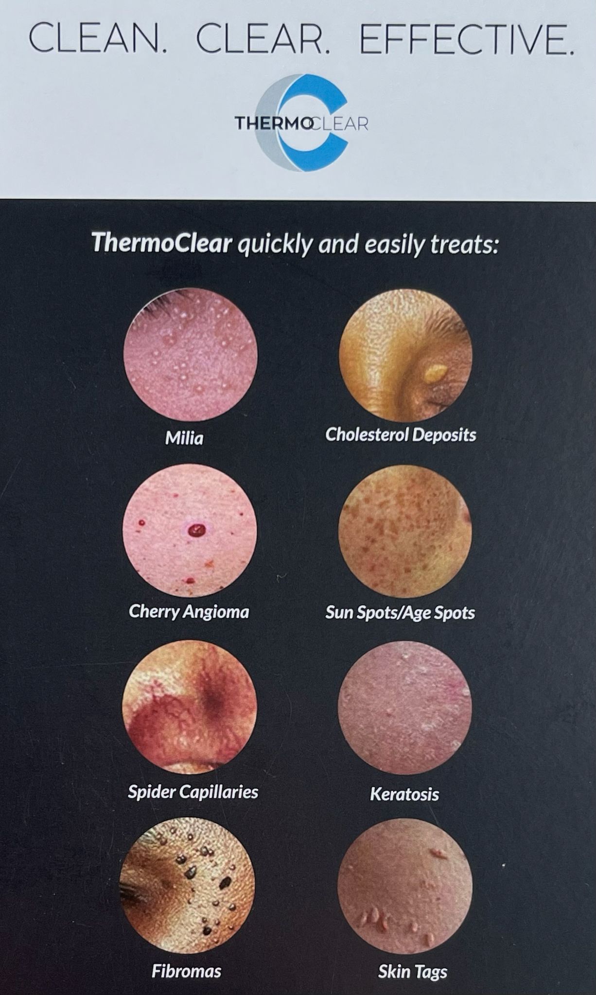 thermoclear-treatment