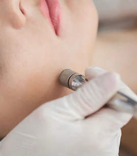 microdermabrasion-facial